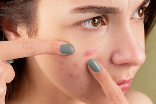 Debunking Acne Myths: Essential Truths You Must Know