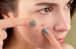 Debunking Acne Myths: Essential Truths You Must Know